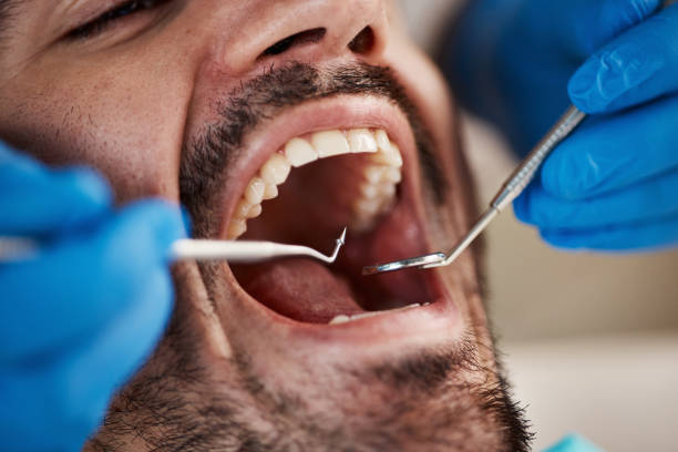 Best Emergency Tooth Extraction in Hemphill, TX